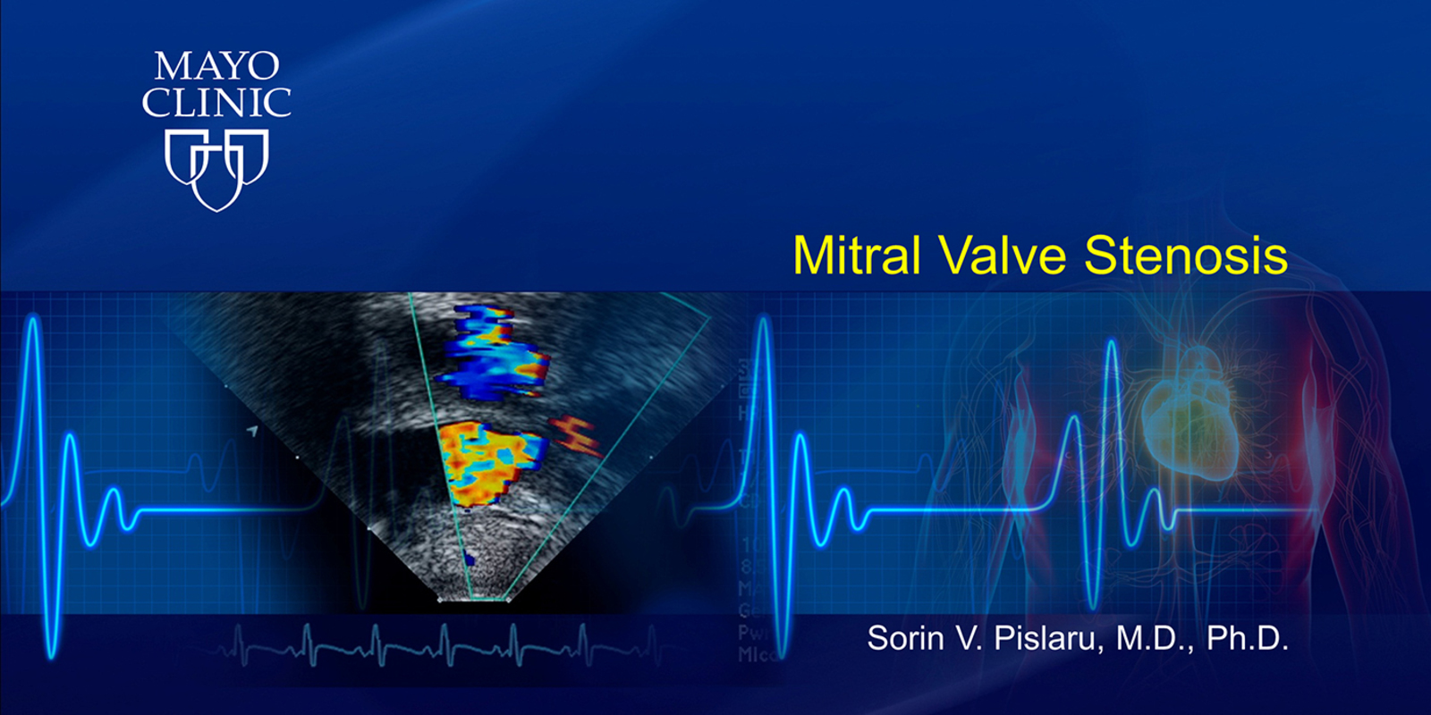 Mitral Valve Stenosis