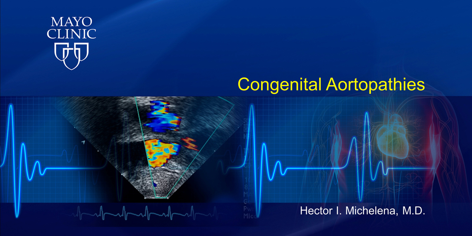 Congenital Aortopathies