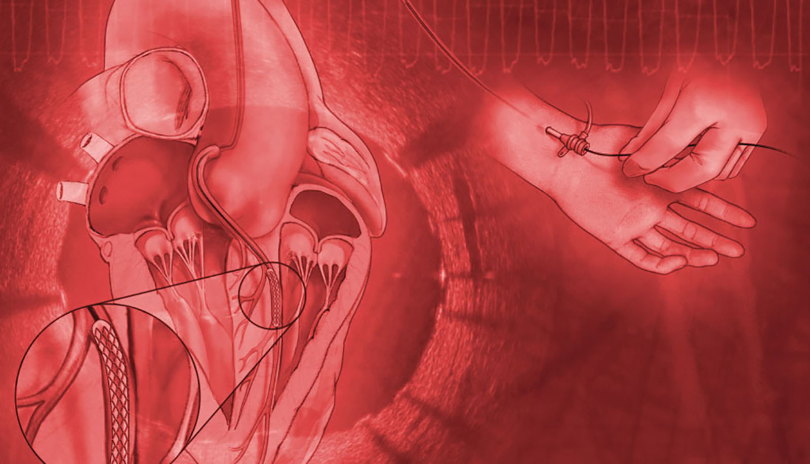 Interventional Cardiology Online Board Review