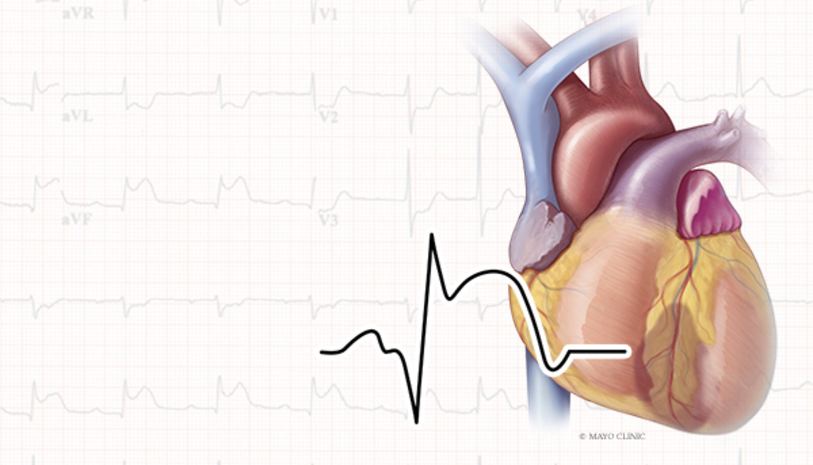 Spontaneous Coronary Artery Dissection (SCAD) | Cardiovascular Medicine CME