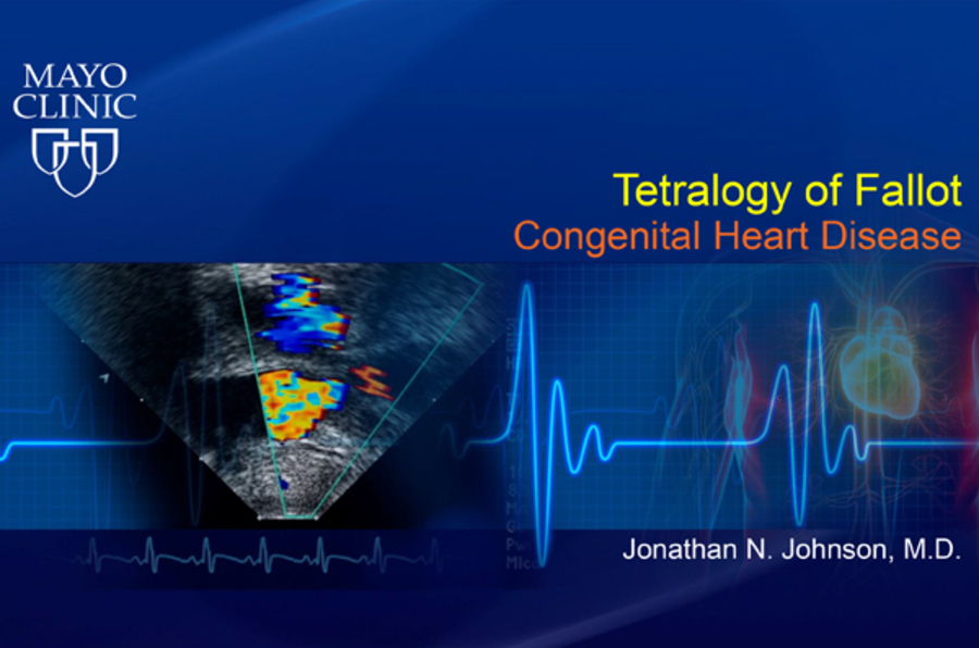 Tetralogy of Fallot