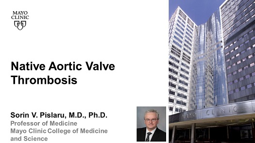 Pislaru native aortic valve thrombosis