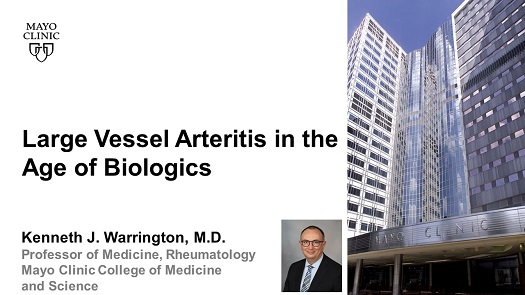 Warrington large vessel arteritis in the age of biologics